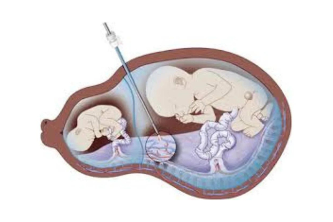 Fetal Interventions