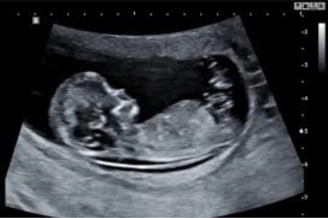 First Trimester Obstetric Ultrasound