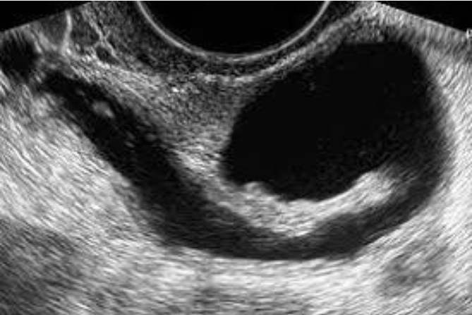 Gynecology Ultrasound