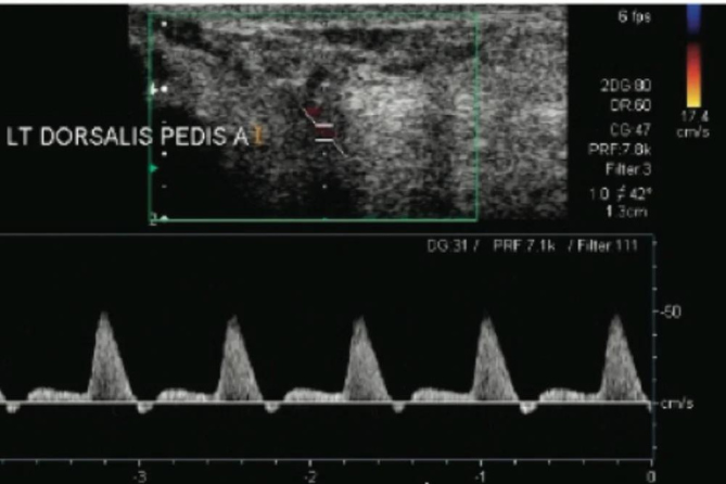 Peripheral Vascular Doppler